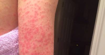 Experts indicate eight types of skin rash that could be a symptom of Covid - dailyrecord.co.uk - China - Britain - Scotland - city London