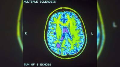 Epstein-Barr virus could lead to multiple sclerosis, Harvard study finds - fox29.com