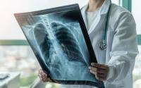 Reported TB cases drop in US amid COVID-19 - cidrap.umn.edu - Usa