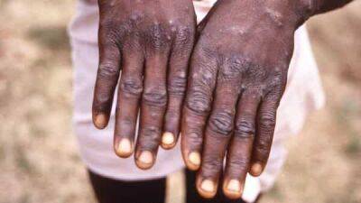 Is monkeypox going to be next pandemic? Know what WHO said in emergency meeting - livemint.com - India - Nigeria