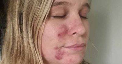 Mum felt 'like a monster' and hid her face from daughter when struck with cystic acne after Covid - manchestereveningnews.co.uk - city Manchester