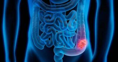 Colorectal cancer cases rising among younger adults in Canada and U.S. - globalnews.ca - Usa - Canada - county Holmes - city Elizabeth, county Holmes