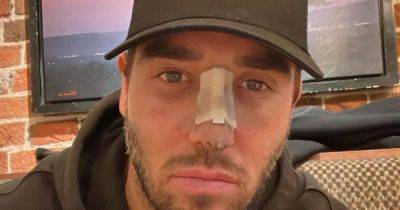 Curtis Pritchard - James Lock - TOWIE's James Lock reveals 'new face' with horrifying before and after pics - ok.co.uk - Britain - Turkey