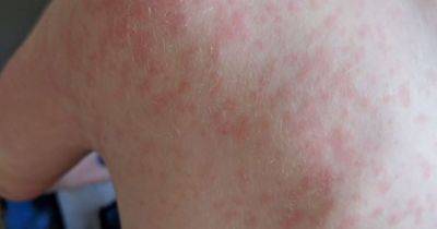 Measles outbreak: The lesser-known symptoms to be aware of before red rash develops - manchestereveningnews.co.uk - Britain
