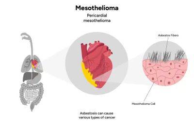 What Makes Mesothelioma So Deadly? - curiousmindmagazine.com