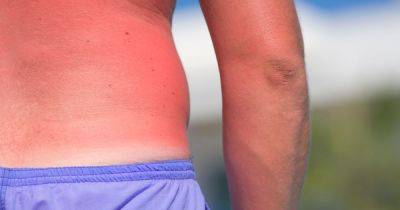 NHS tips for treating sunburn and when you should consider seeing a doctor - dailyrecord.co.uk - Scotland