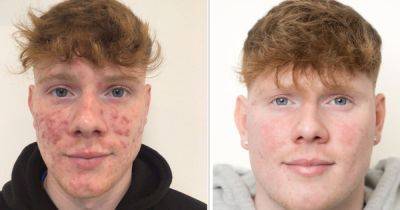 Rutherglen man has life transformed after year-long treatment cures severe acne - dailyrecord.co.uk